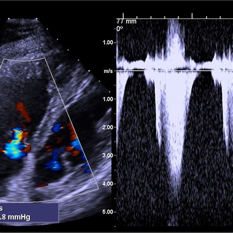 normal left ventricular systolic function.